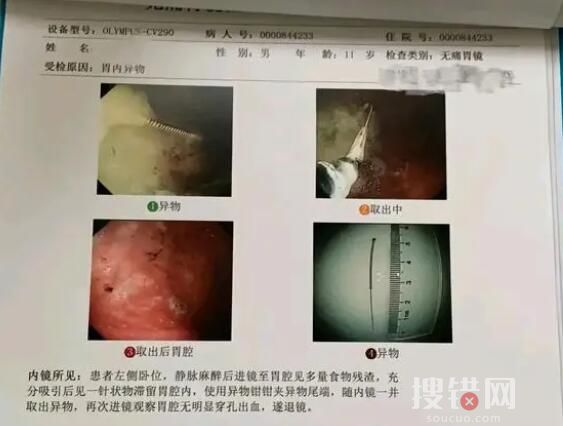 寶媽稱醫院誤將針掉進孩子胃中 原因竟是這樣簡直太驚險了